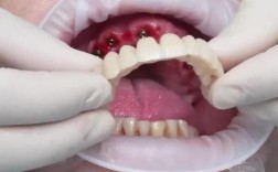 半口牙拔除后种牙全过程，到底要经历哪些关键步骤？