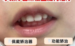 儿童深覆盖的治疗方法有哪些？不同年龄段和病因下如何选择最优矫正方案？