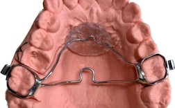 正畸腭杆制作时机