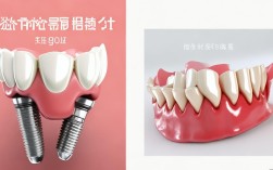 2025年选种植牙还是活动义齿？哪个更值得？