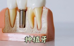 植得种植牙效果如何？真的能用一辈子吗？