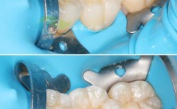 牙齿矫正发现龋齿