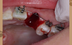 正畸拔牙一颗5一颗六