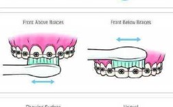 正畸刷牙方法图解