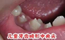 正畸尖牙牙根凸出是什么原因？会影响矫正效果吗？
