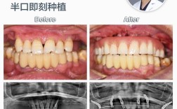 种牙 植骨 松动