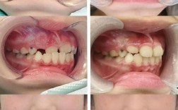 儿童牙齿矫正前后，牙齿变化有多大？家长需注意这些！