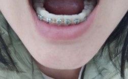 杭州成人做口腔正畸，效果好不好？年龄有限制吗？