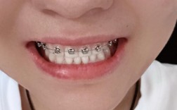 单颗牙齿矫正有哪些方法？怎么选最合适？