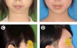 正畸后改变下颌后缩