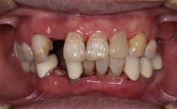 牙种深了会有什么问题吗？