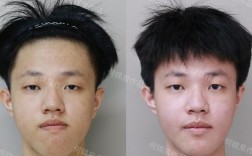 正颌术后正畸治疗一般需要多长时间？