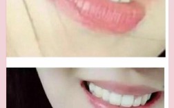 27岁女牙齿矫正