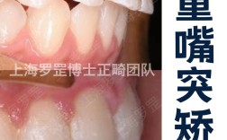 上海口腔科矫正牙齿，哪家医院靠谱效果好？