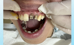 根管治疗后能正畸吗？时机与注意事项如何？