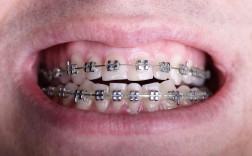 正畸铁丝移动到一边