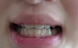 牙齿矫正后反弹严重吗？反弹后该如何应对？