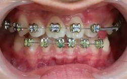 牙齿矫正器刚带很痛