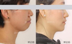 牙齿矫正侧面对比，侧脸改善效果差异明显吗？