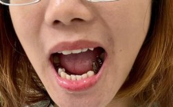 夏季种牙，牙缺失者需注意什么？时机、护理全解析！