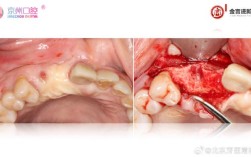 正畸与引导组织再生术