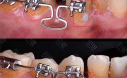 正畸钢丝末端回弯