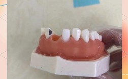 全瓷牙的制备方法视频