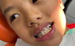 小孩牙齿突出矫正的最佳年龄是几岁合适？