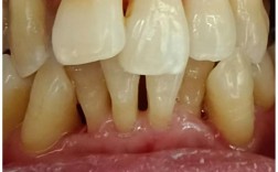 重度牙周炎缺失牙，种植牙可行吗？需先治牙周炎吗？