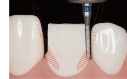 开窗式贴面预备方法的关键技术步骤及临床应用价值是什么？