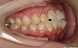 矫正牙齿拔尖牙，是必须步骤还是可选方案？