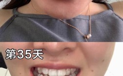 骨性地包天正畸后效果