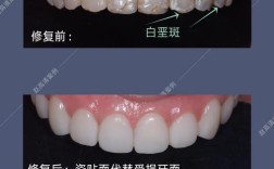 种植牙后贴面有必要吗？效果及注意事项有哪些？
