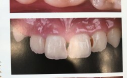 树脂修复怎么治？效果和注意事项有哪些？