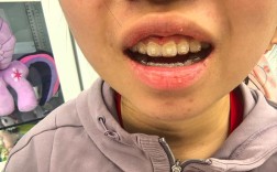 正畸首次复诊没换钢丝，是正常的吗？