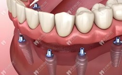 江门哪里可以种牙？靠谱医院和医生怎么选？