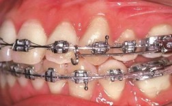 正畸滑动杆弯制图片