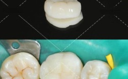 聚合瓷嵌体粘结方法的关键步骤、材料选择及注意事项有哪些？