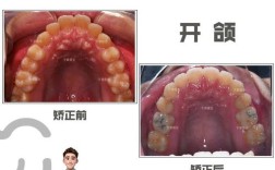 下巴响矫正牙齿