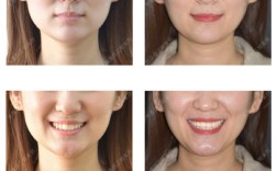 牙齿矫正前后脸型变化大不大？矫正效果如何影响脸型？