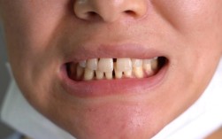 正畸下前牙骨开裂，原因是什么？如何预防与应对？