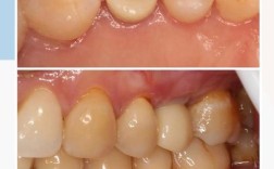 种牙后一个月为何还痛？原因究竟是什么？