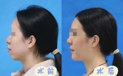 第一例颌骨正畸手术