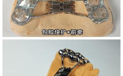 口腔正畸用什么牵引器