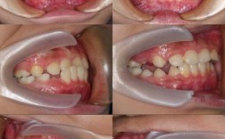 南京牙齿矫正后效果能维持多久？需注意哪些护理事项？