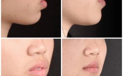 深覆合正畸前后对比