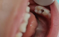 龋齿患者能做牙齿矫正吗？