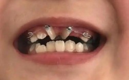 33岁矫正牙齿晚了吗？现在开始还来得及吗？