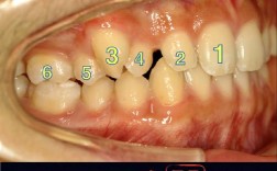正畸低角病例关间隙