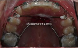 正畸游离埋伏牙牵引的难点与解决方法是什么？